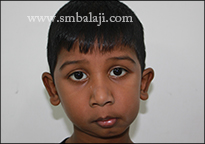 TMJ Ankylosis 17 Facial Asymmetry Due To Unilateral Tmj Ankylosis