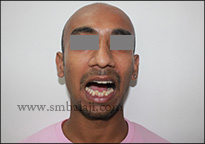Immediately After Trauma - Inability To Open The Mouth Normally