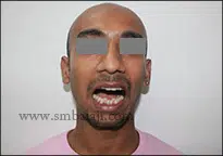 Triumph Over TMJ Trauma: A Success Story 1 Immediately After Trauma - Inability To Open The Mouth Normally