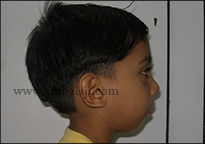 TMJ Trauma 17 Profile View Following Successful Tmj Reconstruction
