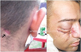 Ballistic (Gunshot) Injury 2 Bullet Entry And Exit Wound
