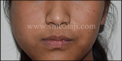 Pre-Operative Image Showing Huge Swelling In The Right Side Of The Face