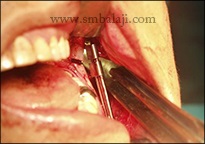TMJ Growth Defects 6 Distractor Being Fixed