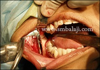 TMJ Growth Defects 2 Distractor Device Being Placed