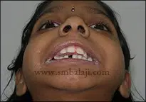 2. Preoperative View Showing Decreased Mouth Opening