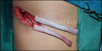 Costochondral Rib Graft Harvested To Reconstruct The Affected Portion Of Mandible