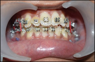 Improved Bite Following Surgery Giving Enhanced Appearance