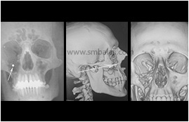 Path Of The Bullet Leading To Fracture Of The Upper Jaw, Eye Bone And Sinus