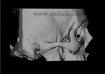 3D Ct Showing Tmj Joint Space Obliteration On Both Sides With Fused Bony Mass-Tmj Ankylosis