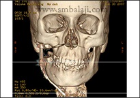 TMJ Growth Defects 3 Ct Scan Image Showing Progress Of Treatment