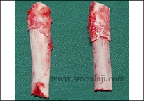 TMJ Ankylosis 12 Costochondral Grafts (Rib Grafts ) Harvested