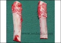 Costochondral Grafts (Rib Grafts ) Harvested