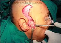Triumph Over TMJ Trauma: A Success Story 3 During Surgery-Bone Plate Placed To Stabilize Condyle Fracture