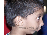 TMJ Trauma 10 Profile View Showing Retruded Lower Jaw