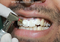 3. Tooth Polishing