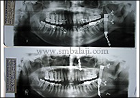 TMJ Growth Defects 7 X-Rays Taken During Start And End Of Distraction Procedure