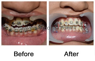 deviated lower jaw – facial asymmetry Before - After