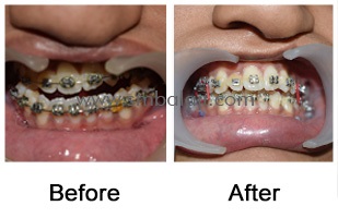 Successful correction of long and deviated lower jaw – facial asymmetry without any scars