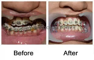 deviated lower jaw – facial asymmetry Before - After