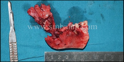 Cystic Lesion Along With The Affected Bone And Teeth Removed In Toto