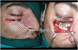 Reconstruction Of Eye Socket Floor Using Titanium Mesh And Cartilage Graft From Patient'S Rib