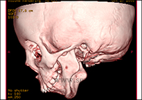 TMJ Trauma 11 Ct Scan Image Showing Fused Right Tm Joint