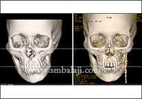 TMJ Growth Defects 8 Ct Scan Images Before And After Treatment, Facial Asymmetry Corrected With Distraction Osteogenesis
