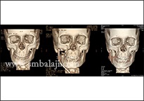 TMJ Growth Defects 4 Ct Scan Images Before, During And After Correction Of Facial Asymmetry With Distraction Osteogenesis