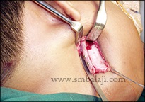 TMJ Ankylosis 13 Gap Arthroplasty Surgery With Costochongral Graft