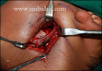 TMJ Ankylosis 19 Tmj Reconstruction Surgery