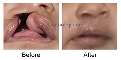 Unilateral Cleft Lip & Palate Surgery Before After Surgery