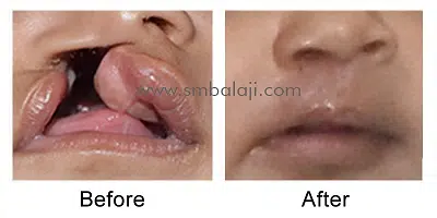 Unilateral Cleft Lip &Amp; Palate Surgery Before After Surgery