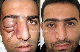 Ballistic (Gunshot) Injury 5 Before And After Surgery