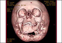 TMJ Trauma 12 Ct Scan Image Showing Abnormal Jaw Growth Due To Tmj Ankylosis