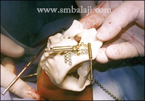 TMJ Growth Defects 9 During Surgery-Planning The Distraction Using Sterolithographic Model