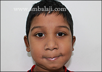 TMJ Ankylosis 20 Face Asymmetry Corrected Following Surgery