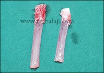 Harvested Rib Grafts (Costochondral Grafts)