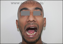 Improved Mouth Opening Following Surgery