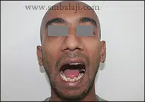 Triumph Over TMJ Trauma: A Success Story 5 Improved Mouth Opening Following Surgery