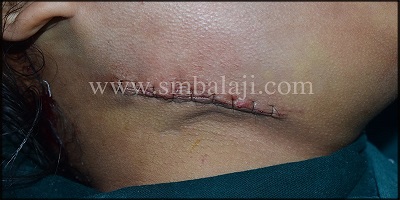 Immediately After Suturing Extra Oral View