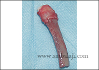 TMJ Trauma 13 Bone Graft Taken From The Rib