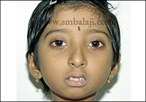 TMJ Ankylosis 15 Improved Facial Appearance And Chin Made More Prominent Following Surgery