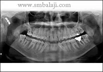 Triumph Over TMJ Trauma: A Success Story 6 Post Operative X-Ray Showing Good Healing Of The Fractured Bone Segments