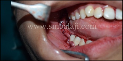 Immediately After Suturing Intraoral View