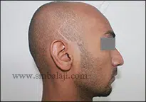 Triumph Over TMJ Trauma: A Success Story 7 Barely Visible Scar And Good Healing Following Surgery