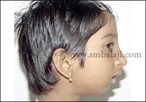 TMJ Ankylosis 16 Enhanced Facial Profile Following Surgery