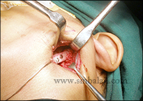 TMJ Trauma 14 Graft Used To Reconstruct Tmj