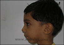 TMJ Trauma 16 Profile View Following Successful Tmj Reconstruction