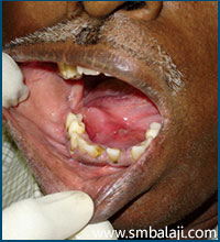 A Bulge On The Right Side Of The Floor Of The Mouth Indicating The Presence Of Submandibular Gland Calculus