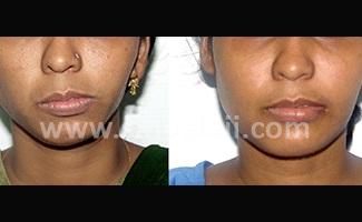 After Distractor Device Is Removed, Successful Completion Of Distraction To Treat Face Asymmetry